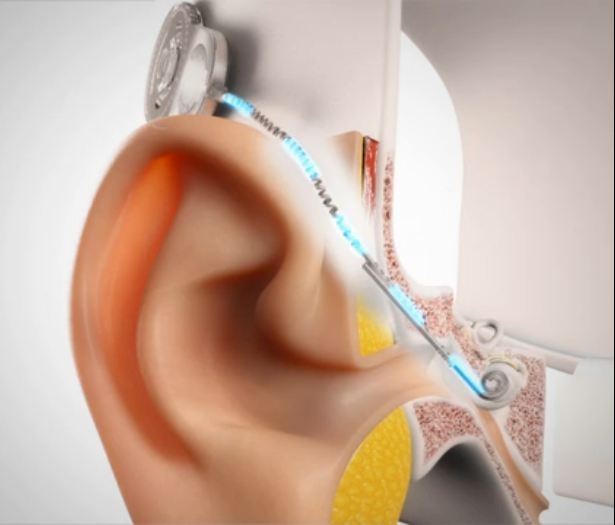 Cochlear Implant Awareness Programme in Faridabad