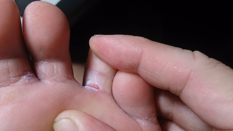 Home remedies for fungal infection in monsoon