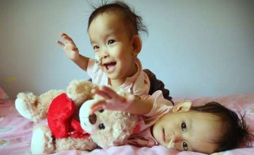  Bhutanese conjoined twins discharged after surgery in Australia 