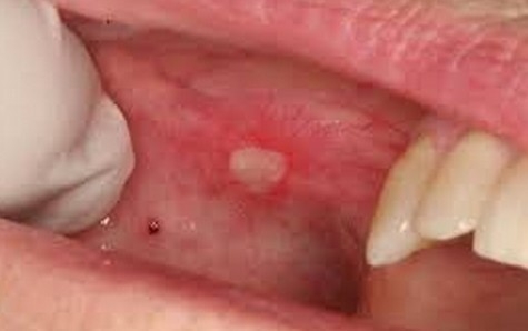 New device that can reportedly diagnose cancers of the mouth within 15 minutes