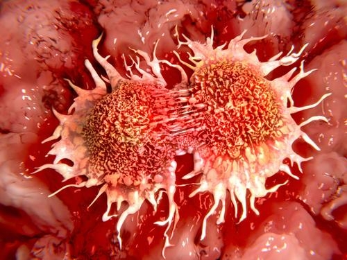  New ML models to predict cancer symptoms, severity 