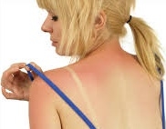  How to soothe a sunburn 