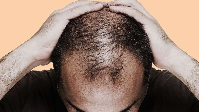  Decoded: Why you turn bald or have grey hair 