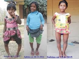  Fluoride contamination cripples over 1,000 children in Assam 