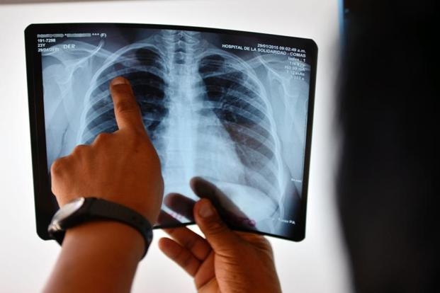  More than 1 mn TB patients lack adequate nutrition 