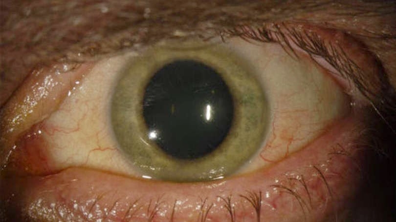  Ebola survivors may have unique retinal scar 
