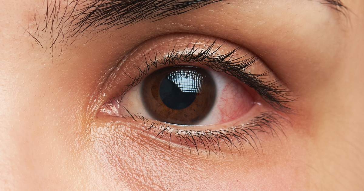  Alert granny spots eye cancer of baby brave heart ( May 14-21 is World Eye Cancer Awareness Week) (With Images) 