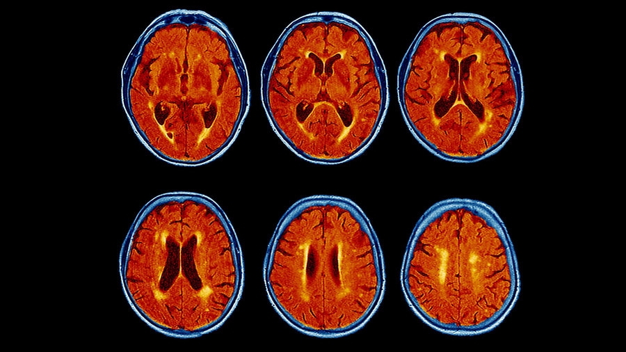  Treatment for Parkinson s might work for Alzheimer s too 