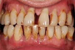  Marijuana use may increase gum disease risk 
