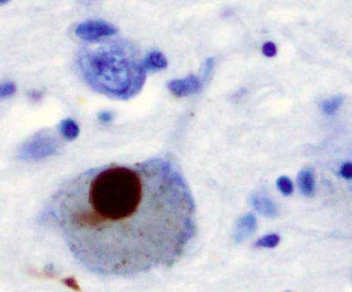  Seasonal flu may increase risk of Parkinson s disease 