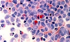  Experimental ovarian cancer treatment  promising , say researchers 