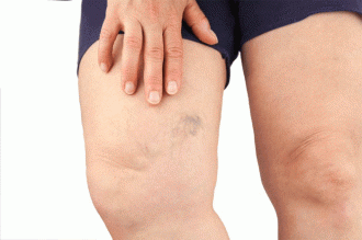 Fortis Hospital introduces new treatment for varicose veins 