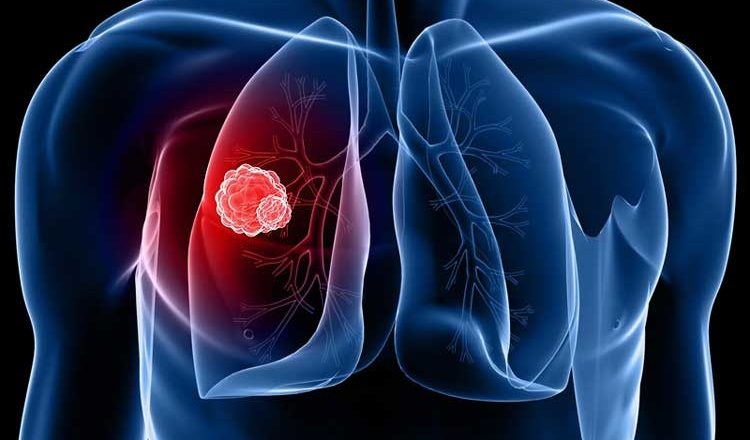  Australians to use chest scans to detect early lung cancer 
