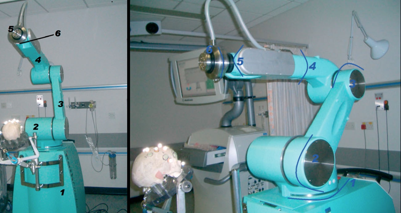  Robotic O-Arm allows for minimal invasive neuro surgery: Doctors 