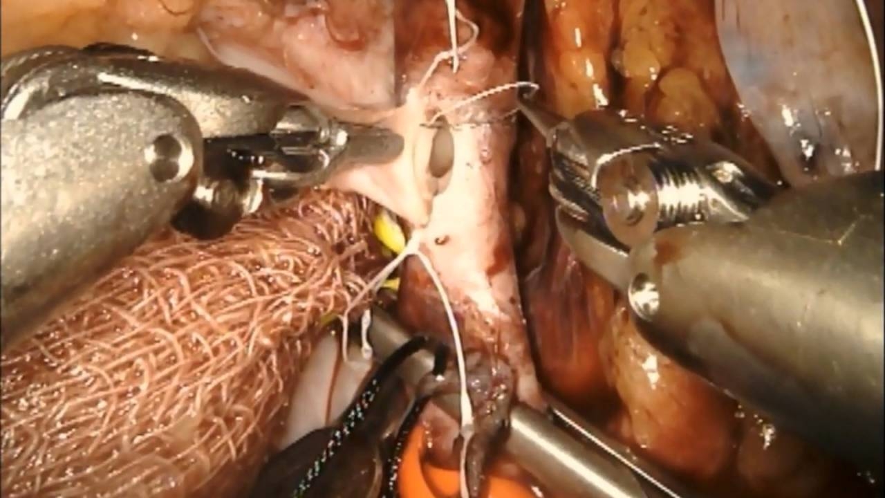  First robotic kidney transplant performed in Maharashtra 