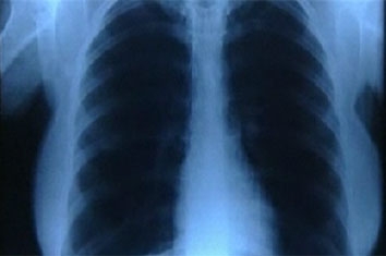  X-rays, even in low dose, may harm your heart 